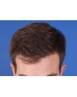 After Hair Transplant&nbsp;Front